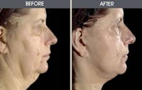 Facelift and Mini Facelift Gallery Before & After Gallery - Patient 2206306 - Image 1