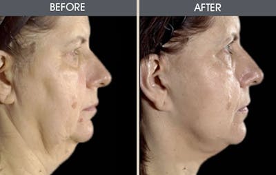 Facelift Before & After Gallery - Patient 2206306 - Image 1