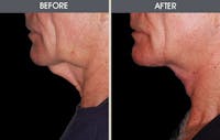 Neck Lift Gallery Before & After Gallery - Patient 2206310 - Image 1