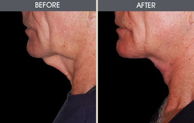 Neck Lift Before & After Gallery - Patient 2206310 - Image 1