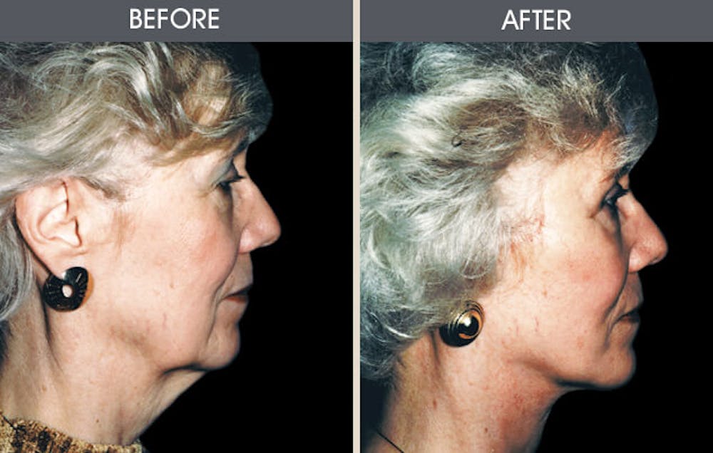 Facelift and Mini Facelift Gallery Before & After Gallery - Patient 2206325 - Image 1