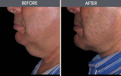 Neck Lift Gallery Before & After Gallery - Patient 2206324 - Image 1