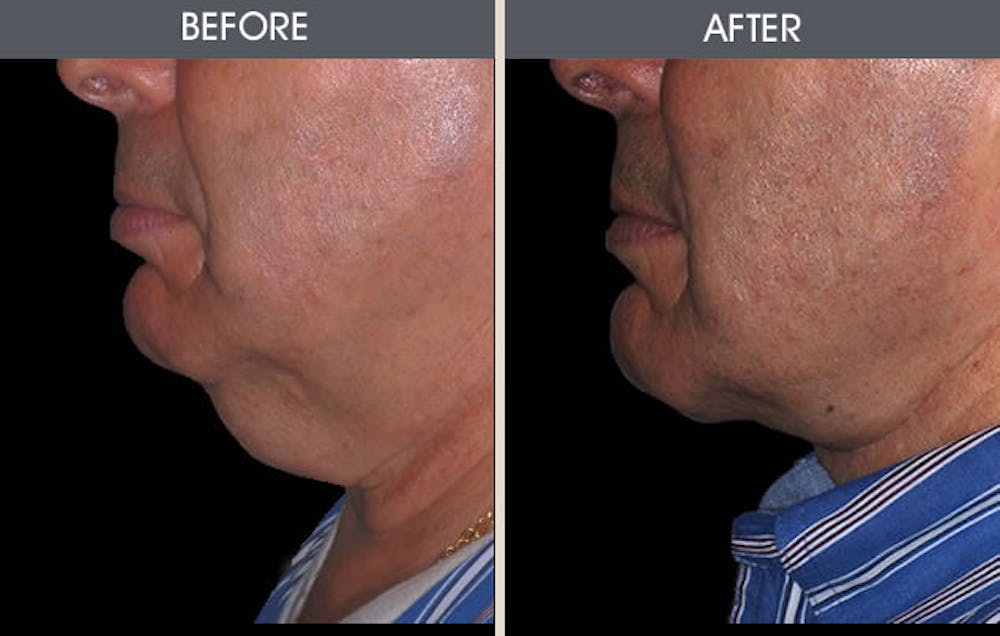 Neck Lift Before & After Gallery - Patient 2206324 - Image 1