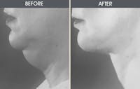 Neck Lift Before & After Gallery - Patient 2206326 - Image 1