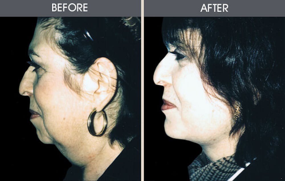 Facelift and Mini Facelift Gallery Before & After Gallery - Patient 2206327 - Image 1