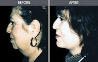 Facelift and Mini Facelift Gallery Before & After Gallery - Patient 2206327 - Image 1