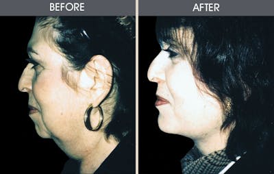 Facelift and Mini Facelift Before & After Gallery - Patient 2206327 - Image 1