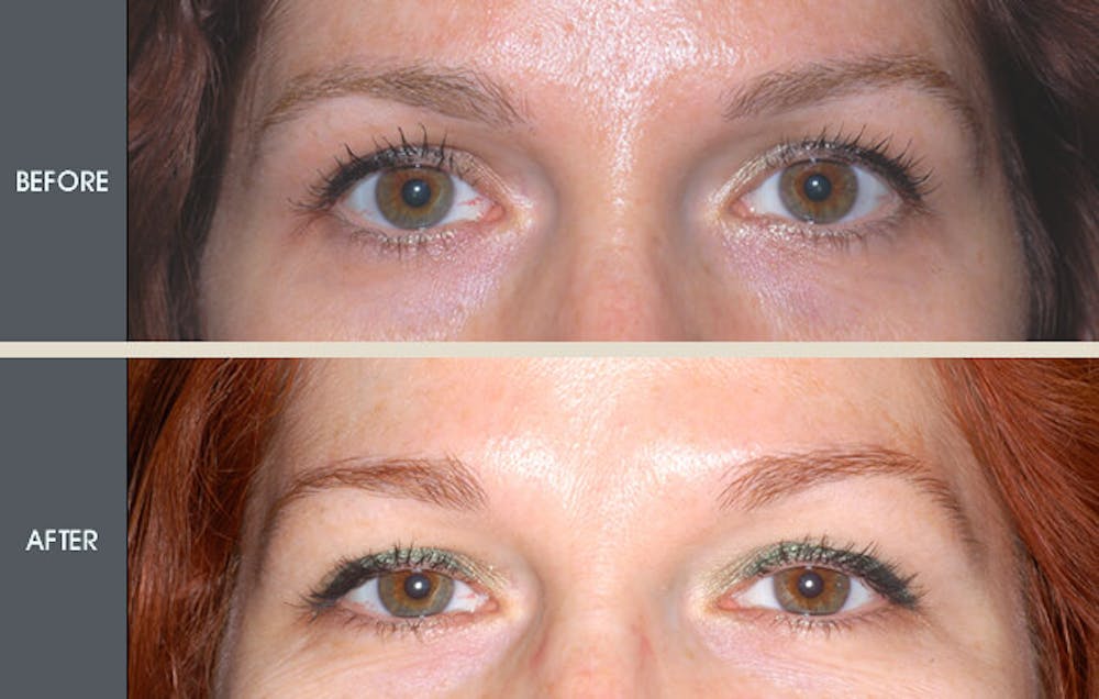Brow Lift Before & After Gallery - Patient 2206329 - Image 1