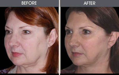 Facelift Before & After Gallery - Patient 2206354 - Image 1