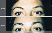 Brow Lift Gallery Before & After Gallery - Patient 2206355 - Image 1