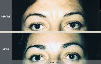 Brow Lift Before & After Gallery - Patient 2206355 - Image 1