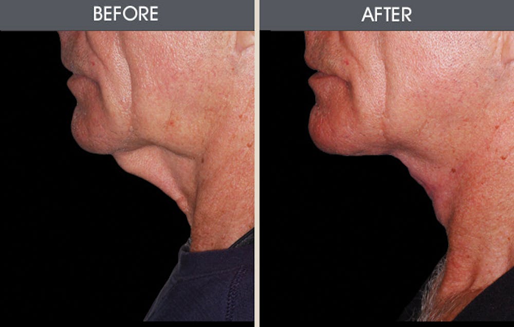 Facelift and Mini Facelift Gallery Before & After Gallery - Patient 2206367 - Image 1