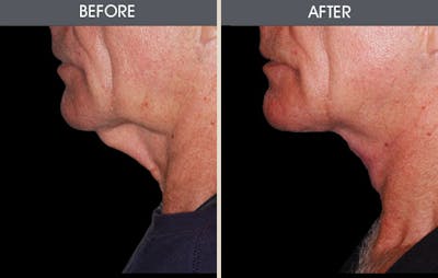 Facelift and Mini Facelift Gallery Before & After Gallery - Patient 2206367 - Image 1