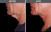 Facelift and Mini Facelift Gallery Before & After Gallery - Patient 2206367 - Image 1