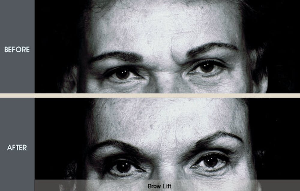Brow Lift Gallery Before & After Gallery - Patient 2206366 - Image 1