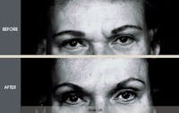 Brow Lift Gallery Before & After Gallery - Patient 2206366 - Image 1
