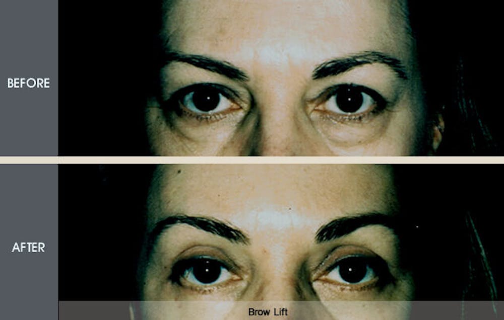 Brow Lift Gallery Before & After Gallery - Patient 2206380 - Image 1