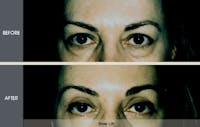 Brow Lift Before & After Gallery - Patient 2206380 - Image 1