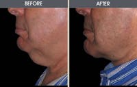 Facelift Before & After Gallery - Patient 2206393 - Image 1