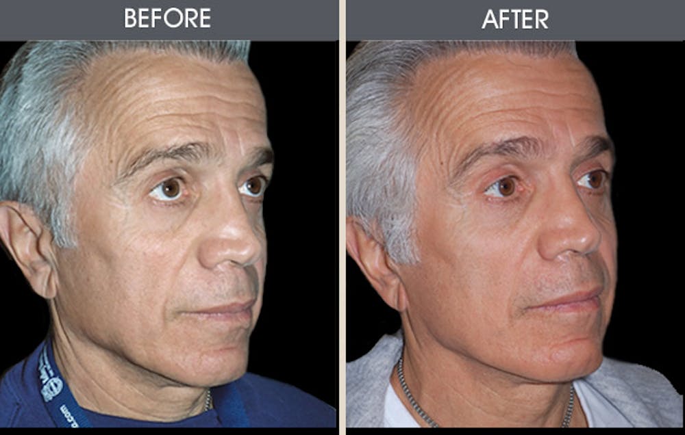 Facelift and Mini Facelift Gallery Before & After Gallery - Patient 2206414 - Image 1