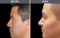 Rhinoplasty Before & After Gallery - Patient 2206417 - Image 1