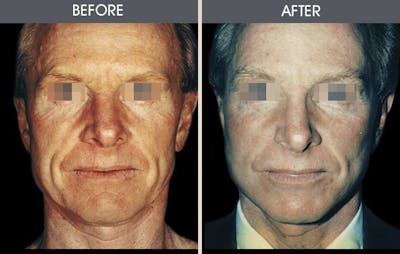 Facelift and Mini Facelift Gallery Before & After Gallery - Patient 2206447 - Image 1