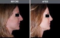 Rhinoplasty Before & After Gallery - Patient 2206458 - Image 1