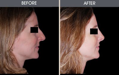 Rhinoplasty Before & After Gallery - Patient 2206458 - Image 1