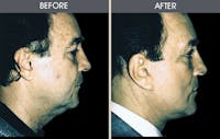 Facelift and Mini Facelift Gallery Before & After Gallery - Patient 2206460 - Image 1