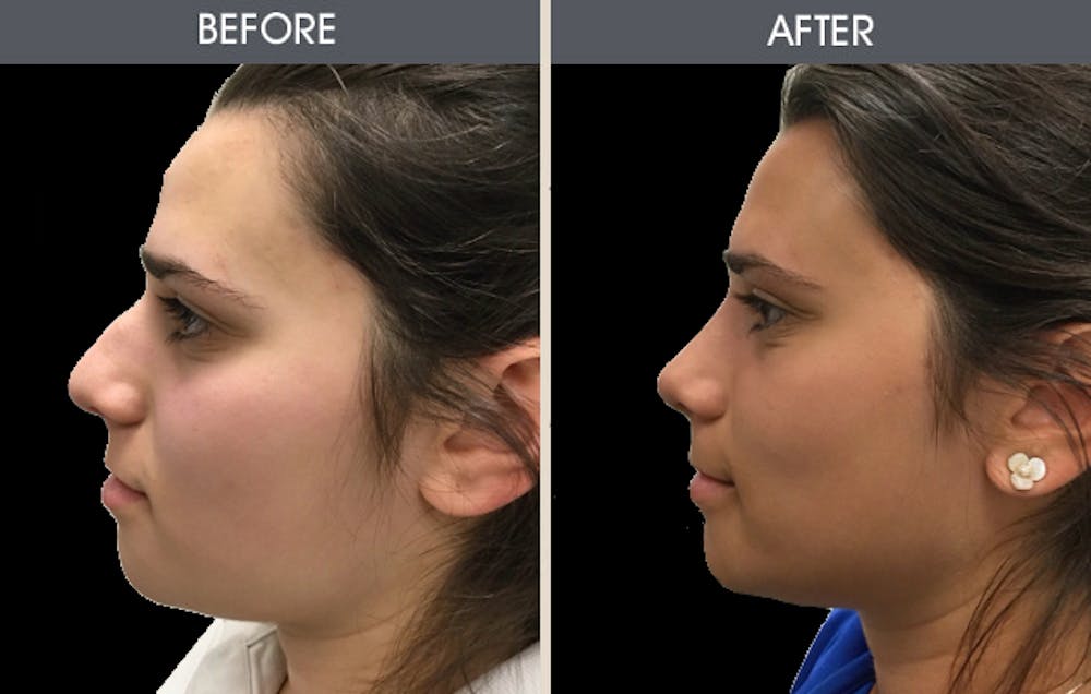 Rhinoplasty Gallery Before & After Gallery - Patient 2206462 - Image 1