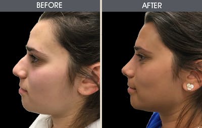 Rhinoplasty Before & After Gallery - Patient 2206462 - Image 1