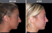 Rhinoplasty Gallery Before & After Gallery - Patient 2206498 - Image 1