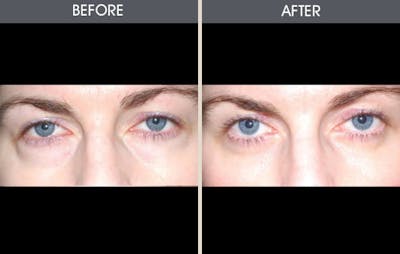 Eyelid Surgery (Blepharoplasty) Gallery Before & After Gallery - Patient 2206499 - Image 1