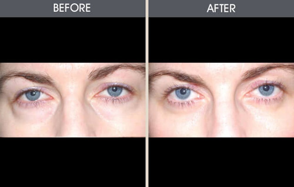Eyelid Surgery (Blepharoplasty)  Before & After Gallery - Patient 2206499 - Image 1
