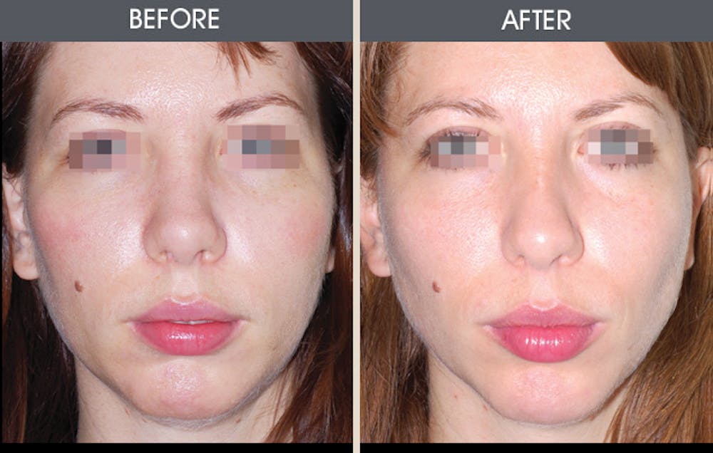 Rhinoplasty Gallery Before & After Gallery - Patient 2206505 - Image 1
