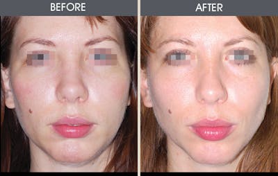 Rhinoplasty Before & After Gallery - Patient 2206505 - Image 1