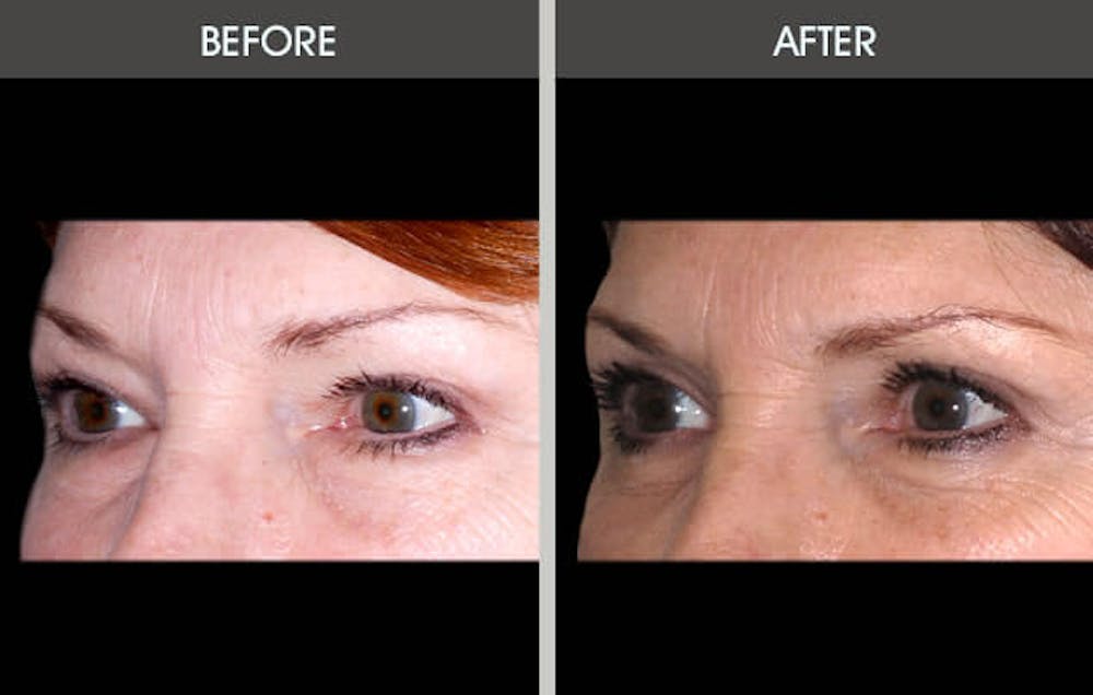 Eyelid Surgery (Blepharoplasty) Gallery Before & After Gallery - Patient 2206504 - Image 1