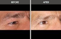 Eyelid Surgery (Blepharoplasty) Gallery Before & After Gallery - Patient 2206533 - Image 1