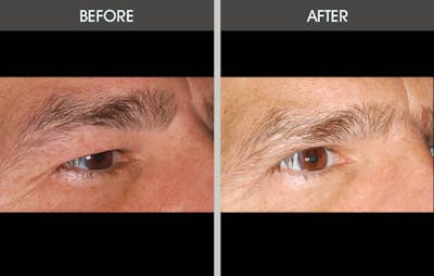 Eyelid Surgery (Blepharoplasty)  Before & After Gallery - Patient 2206533 - Image 1