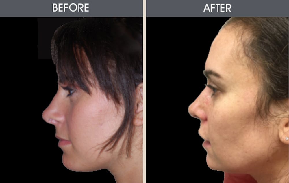 Rhinoplasty Gallery Before & After Gallery - Patient 2206534 - Image 1