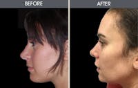 Rhinoplasty Gallery Before & After Gallery - Patient 2206534 - Image 1