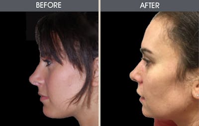 Rhinoplasty Before & After Gallery - Patient 2206534 - Image 1