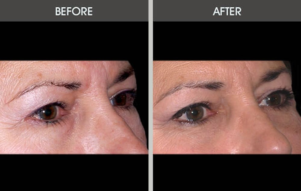 Eyelid Surgery (Blepharoplasty) Gallery Before & After Gallery - Patient 2206536 - Image 1