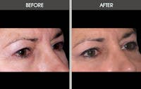 Eyelid Surgery (Blepharoplasty) Gallery Before & After Gallery - Patient 2206536 - Image 1