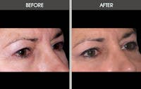 Eyelid Surgery (Blepharoplasty)  Before & After Gallery - Patient 2206536 - Image 1