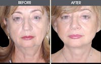 Rhinoplasty Gallery Before & After Gallery - Patient 2206539 - Image 1