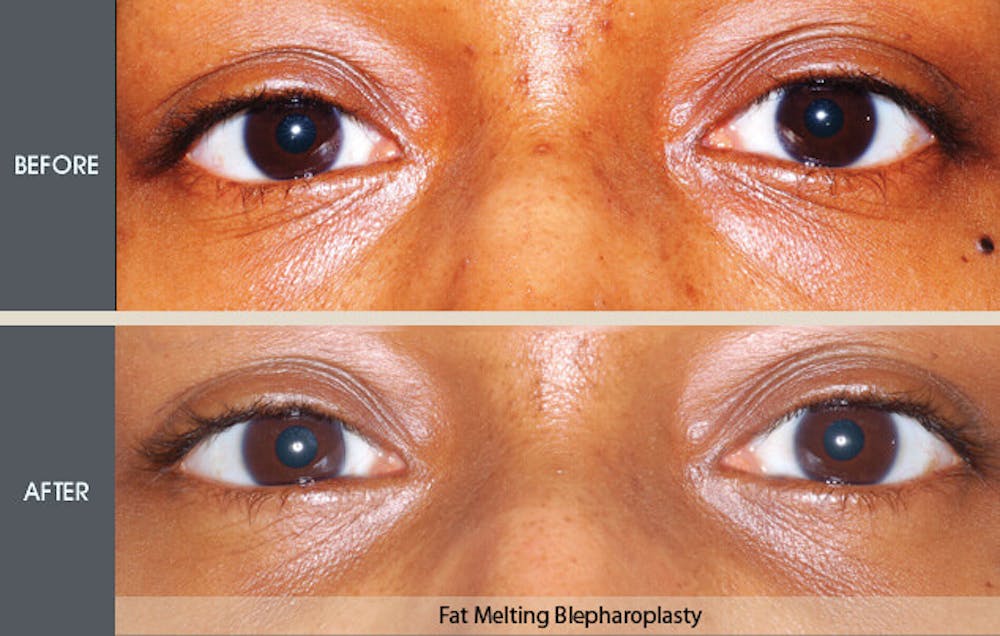 Eyelid Surgery (Blepharoplasty) Gallery Before & After Gallery - Patient 2206561 - Image 1