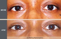 Eyelid Surgery (Blepharoplasty) Gallery Before & After Gallery - Patient 2206561 - Image 1