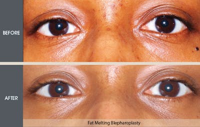 Eyelid Surgery (Blepharoplasty) Gallery Before & After Gallery - Patient 2206561 - Image 1