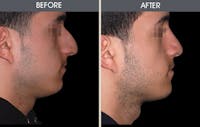 Rhinoplasty Before & After Gallery - Patient 2206571 - Image 1